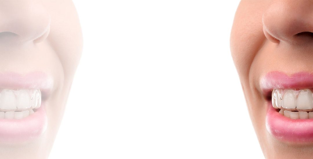 CLEAR ALIGNER- A modern method of correction of malocclusion.